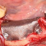Utilizzo di mesh in titanio nella rigenerazione ossea ai fini implantoprotesici: case report