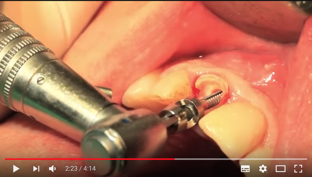 DM_il dentista moderno_estrazione atraumatica verticale