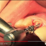 Estrazione atraumatica verticale: protocollo e validazione scientifica DM_il dentista moderno_estrazione atraumatica verticale