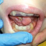 Un paziente pediatrico con sindrome di Lesch Nyhan: piano di trattamento odontoiatrico