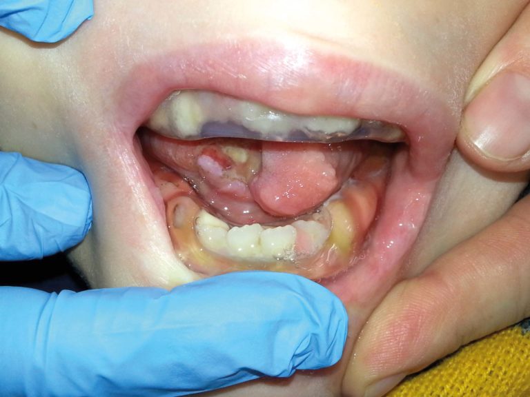 Un paziente pediatrico con sindrome di Lesch-Nyhan: piano di trattamento odontoiatrico