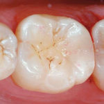 Meccanismi biochimici della perdita di adesione all’interfaccia tra elemento dentale e restauro