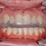 Salute orale e sport: il ruolo dell’odontoiatra sportivo nel team che segue l’atleta