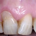 Restoration Guided Creeping Attachment (RGCA): approccio innovativo al trattamento di recessioni gengivali combinate a lesioni cervicali non cariose