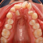 Ortodonzia mini-invasiva con ancoraggio strategico in caso di denti sovrannumerari: case report