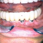 Mucosite perimplantare: aspetti eziologici e terapeutici