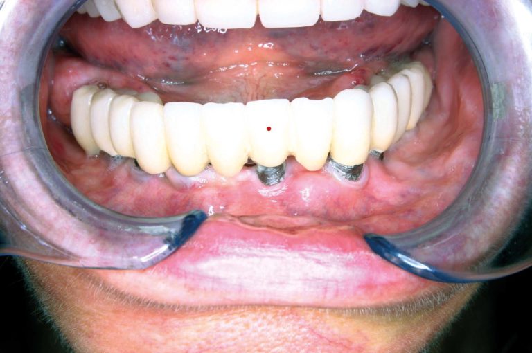 Mucosite perimplantare:  aspetti eziologici e terapeutici