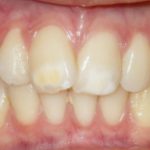 Le anomalie dentarie di struttura nel paziente pediatrico. Cosa sono? Come trattarle?