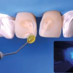 Conservativa diretta nel settore frontale: case report