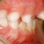 Comportamento eruttivo anomalo di un mesiodens monitorato con CBCT