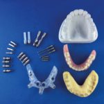 Fast and Easy Loading Procedure (FELP): sistema di gestione di protesi provvisorie in riabilitazioni computer-guidate a carico immediato