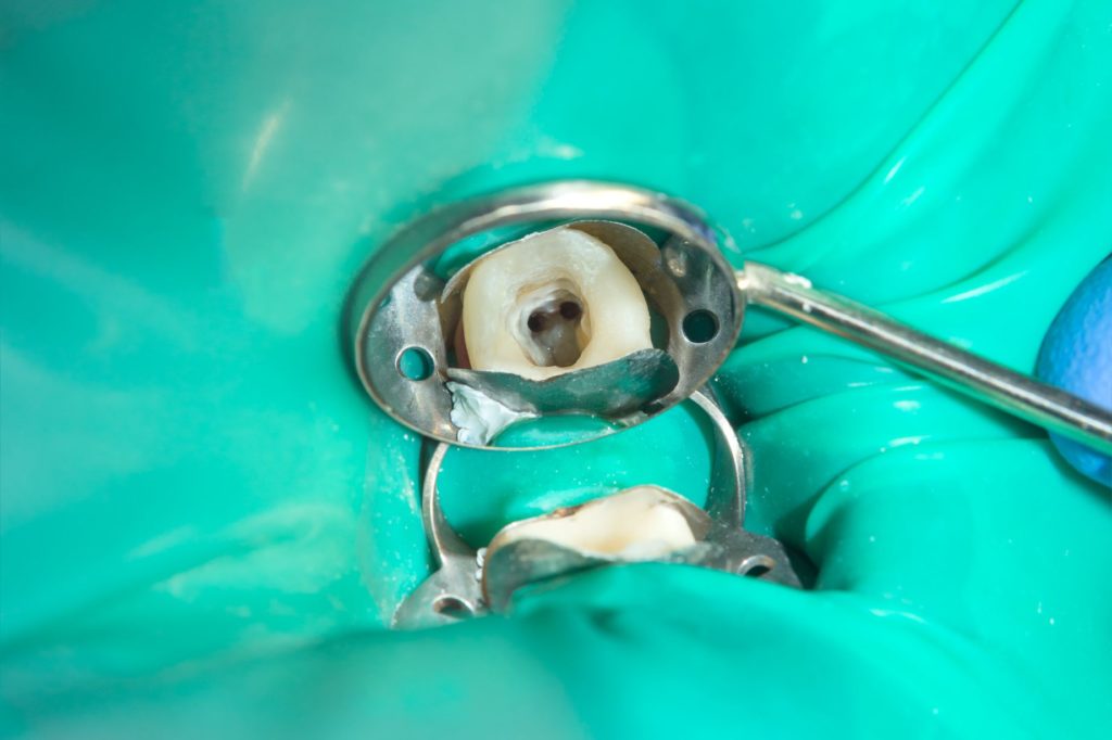 DM_il dentista moderno_anatomia endodontica classificazione