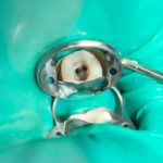 Endodonzia chirurgica: MTA vs. biodentine DM_il dentista moderno_anatomia endodontica classificazione