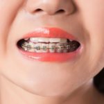 Rendere più veloce il trattamento ortodontico DM_il dentista moderno_vite ortodontica_mini vite_ramo mandibolare_trattamento ortodontico