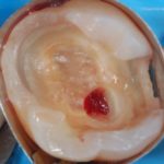 Vital Pulp Therapy, il ragionamento clinico funzionale al successo