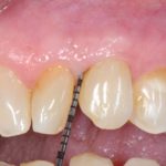 Reimpianto intenzionale di un elemento semi-incluso con l’utilizzo di amelogenine e osso bovino de-proteinizzato Follow up clinico-radiografico a 10 anni