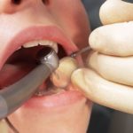 Aspetti odontostomatologici nei pazienti con paralisi cerebrale infantile