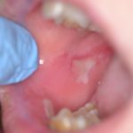 Impiego di gel piastrinico per la cura delle ulcere orali in pazienti affetti da epidermolisi bollosa ulcere orali in pazienti affetti da epidermolisi bollosa