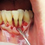 Perio-build-up: una tecnica di recupero con moderni biomateriali di denti con compromissione parodontale molto avanzata