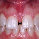 I frenuli labiali: diagnosi e tecniche chirurgiche nel bambino, nell’adolescente e nell’adulto