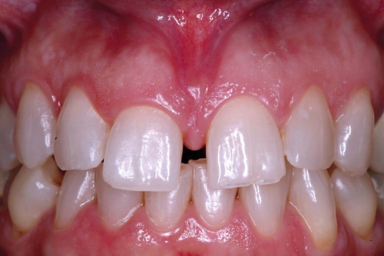 I frenuli labiali: diagnosi e tecniche chirurgiche nel bambino, nell’adolescente e nell’adulto