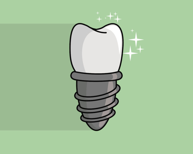 Implantologia nel paziente con osteoporosi