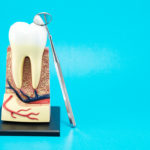 La rimozione dei perni endocanalari DM_il-dentista-moderno_La-rimozione-dei-perni-endocanalari