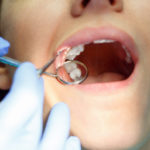 Uprighting con minimpianti ortodontici DM_il-dentista-moderno_mini-impianti-ortodonzia_miniviti ortodontiche.jpg