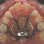 L’espansione del palato, come e quando attuarla