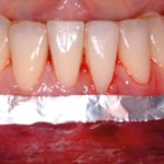 Allineatori ortodontici e ortopedia mandibolare. Case report