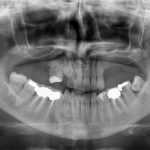 I protagonisti del metal-free: zirconia e disilicato di litio. Caratteristiche e impieghi clinici
