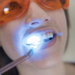 Restauri in composito posizionati con tre diversi adesivi self-etch DM_il dentista moderno_adesivi_materiali dentari