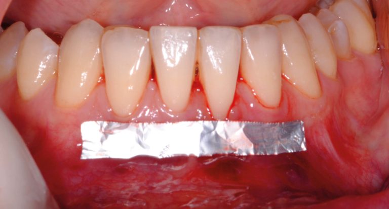 Innesto gengivale libero esteso per il trattamento di una recessione post-ortodontica: un caso clinico