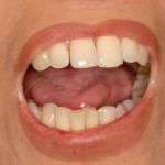 Sclerodermia sistemica e complicanze odontostomatologiche