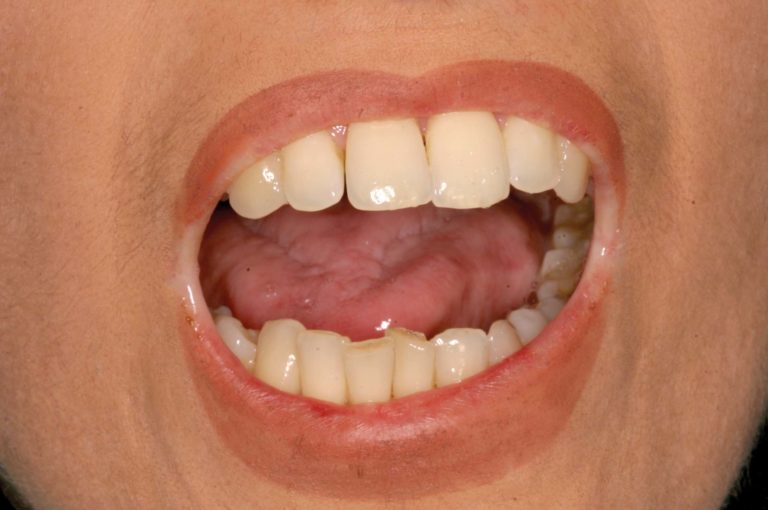 Sclerodermia sistemica e complicanze odontostomatologiche