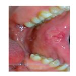 Cheratosi frizionale e morsicatio buccarum