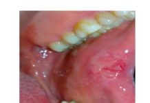 Cheratosi frizionale e morsicatio buccarum