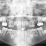 Dente fantasma: aspetti ortodontici e radiologici