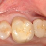 Tecnica minivasiva per il rialzo di seno: case report