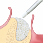 La scelta del materiale da innesto nella rigenerativa ossea Roen