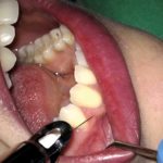 Anestesia intraossea con iniezione controllata da un sistema computerizzato vs tecnica tradizionale di anestesia orale