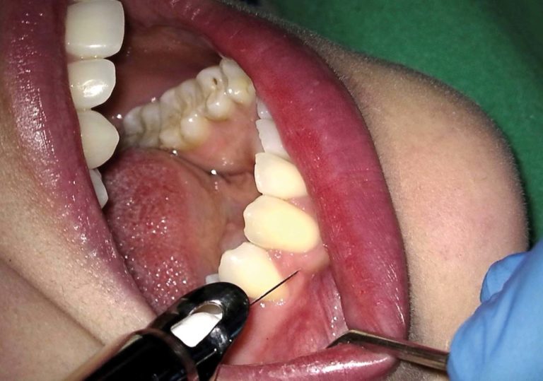 Anestesia intraossea con iniezione controllata da un sistema computerizzato vs tecnica tradizionale di anestesia orale