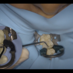 Riabilitazione di II classe: come avere l’approccio più conservativo DM_IL DENTISTA MODERNO_ RIABILITAZIONE DI SECONDA CLASSE