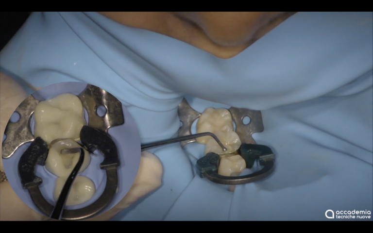 Riabilitazione di II classe: come avere l'approccio più conservativo