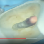 Dente trattato endodonticamente in sede frontale e il perno in fibra