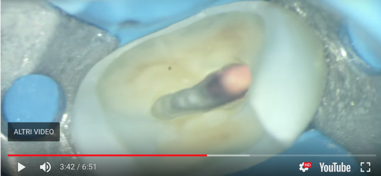 Dente trattato endodonticamente in sede frontale e il perno in fibra 