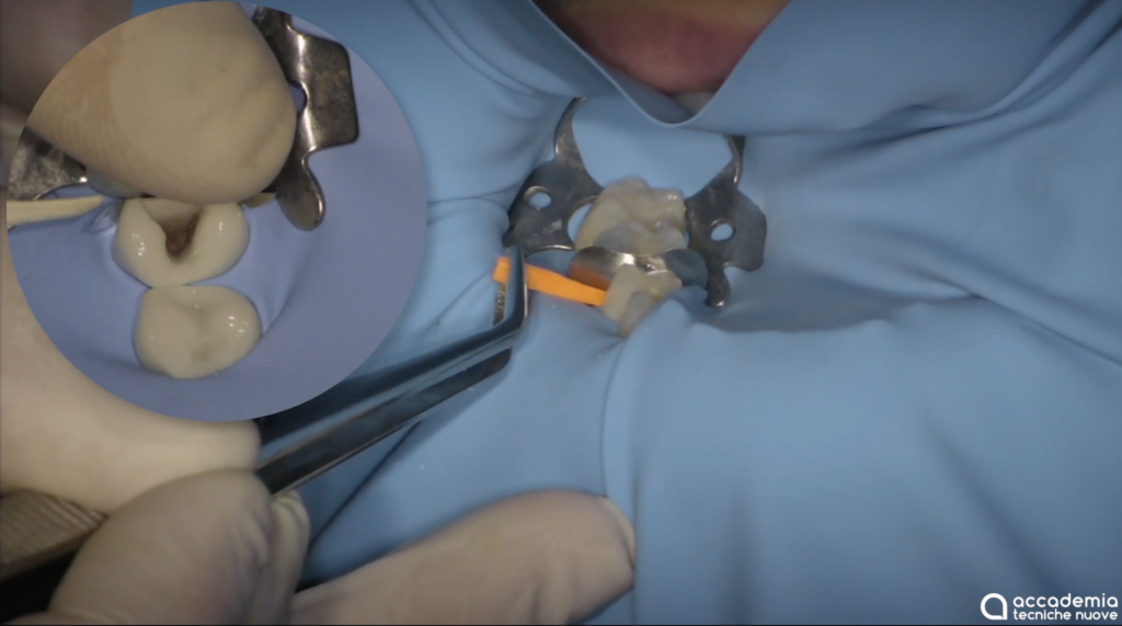 DM_il dentista moderno_II classe riabilitazione