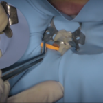 Fattori che influenzano il fallimento dei restauri di II classe DM_il dentista moderno_II classe riabilitazione