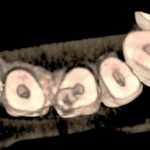 La CBTC in endodonzia