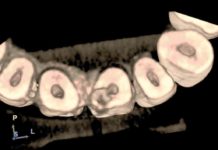La CBTC in endodonzia